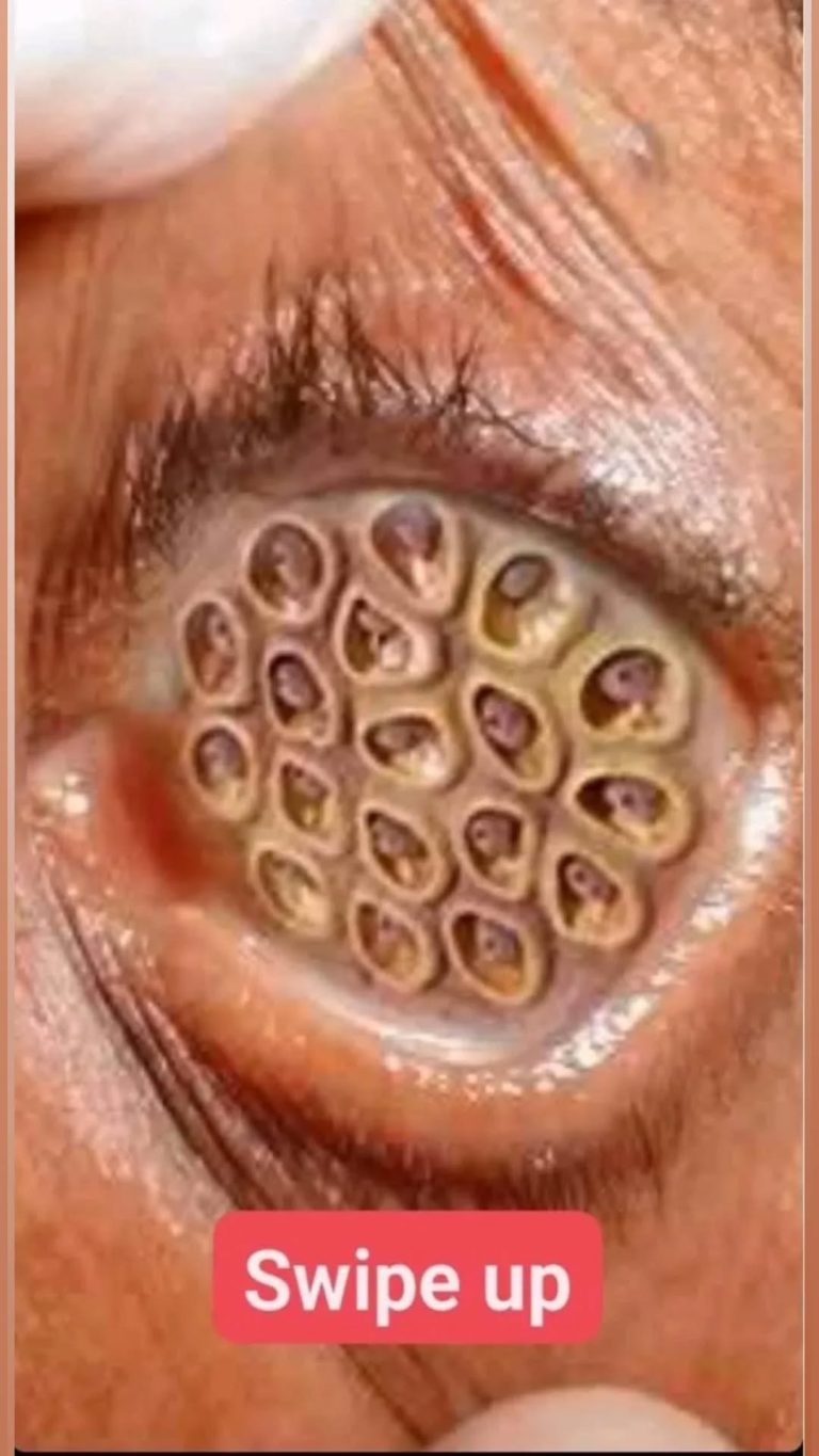 Eye Infections: Symptoms, Treatments, and Prevention