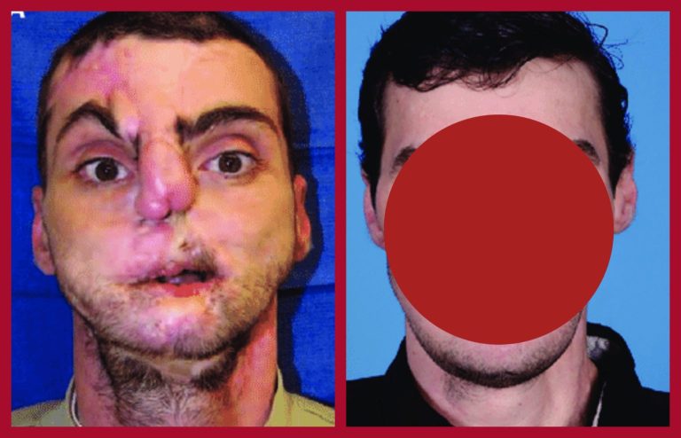 Three patients whose lives were changed after the magical surgery… See the results below…
