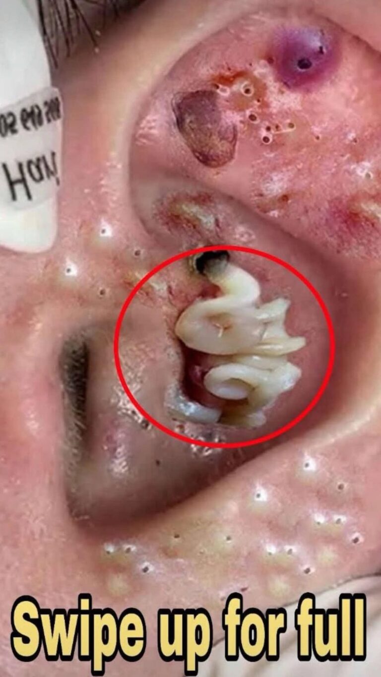 Acne And Everything You Need To Know About Them