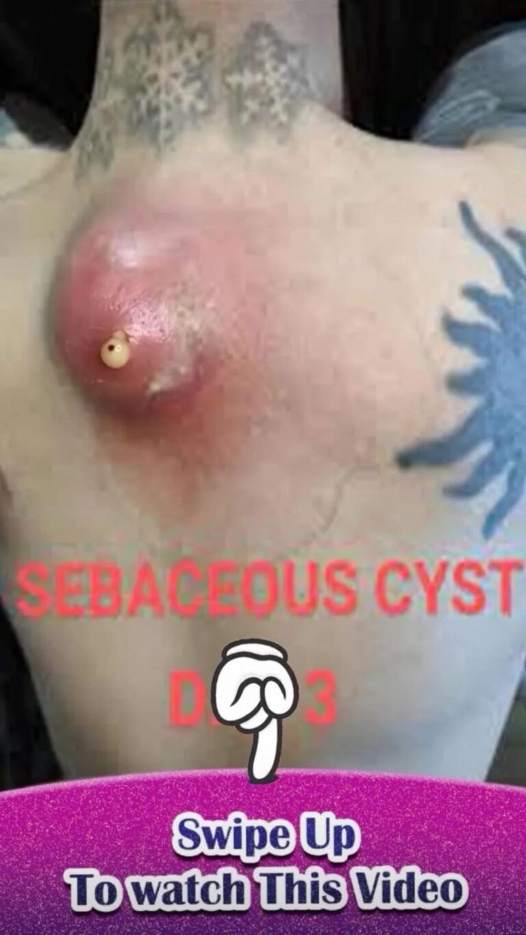 Their acne is severe