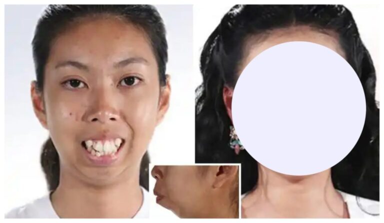 I am no longer ashamed of myself. Incredible surgery is performed on a woman who was born without a CHIN in order to reconstruct her face…