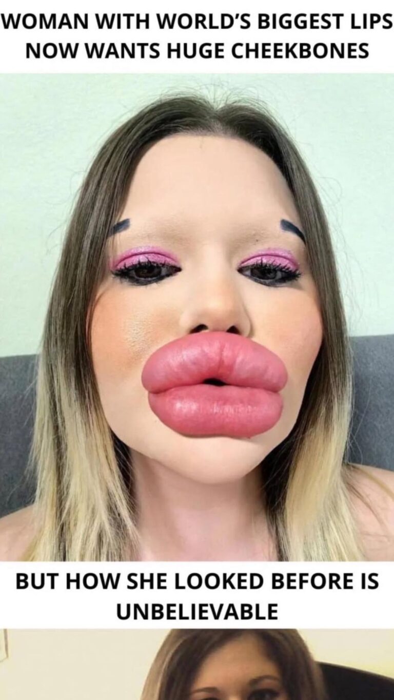 25-Year-Old Bulgarian Woman Does More Than 27 Procedures To Have The Biggest Lips In The World