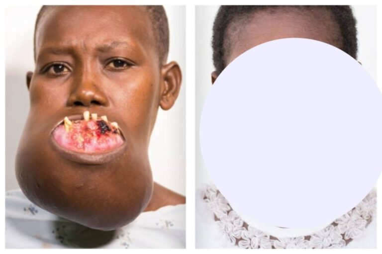 This girl has become a real beauty after the facial surgery… See the result…