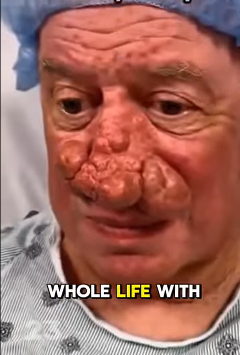 You Won’t Believe How This Man’s Rare Nose Transformed After Surgery… Results Here!