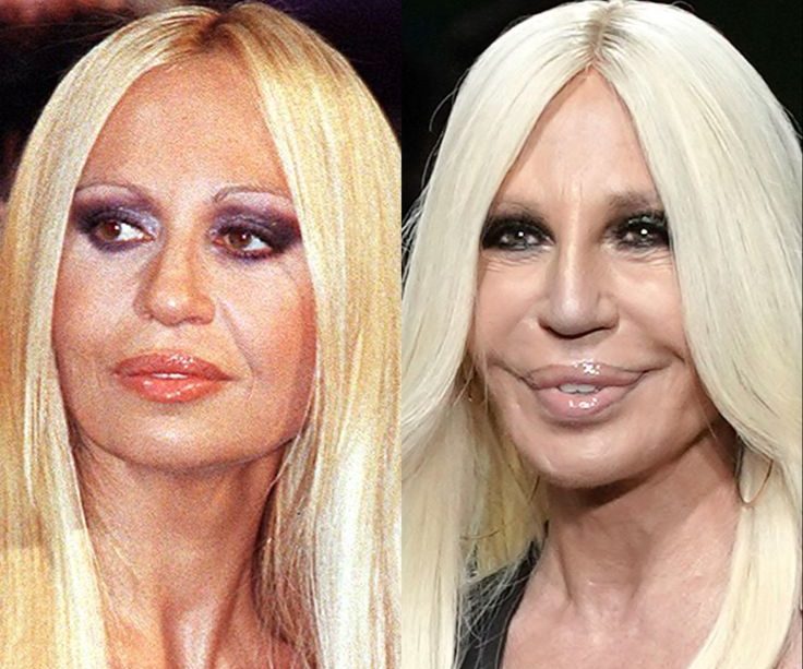 Donatella Versace Before and After Plastic Surgery